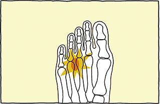 薬指 足 の 指 痛い 足の指が痛い… 体の専門家が対策教えます。