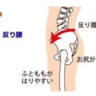 反り腰の原因とは？